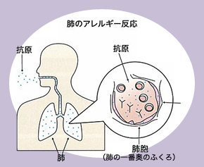 過敏生肺炎のメカニズム